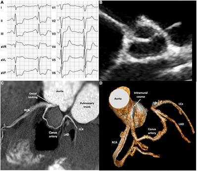 Exertional Dyspnea as the Main Symptom in an Adolescent Athlete With Coronary Artery Anomaly – A Case Report